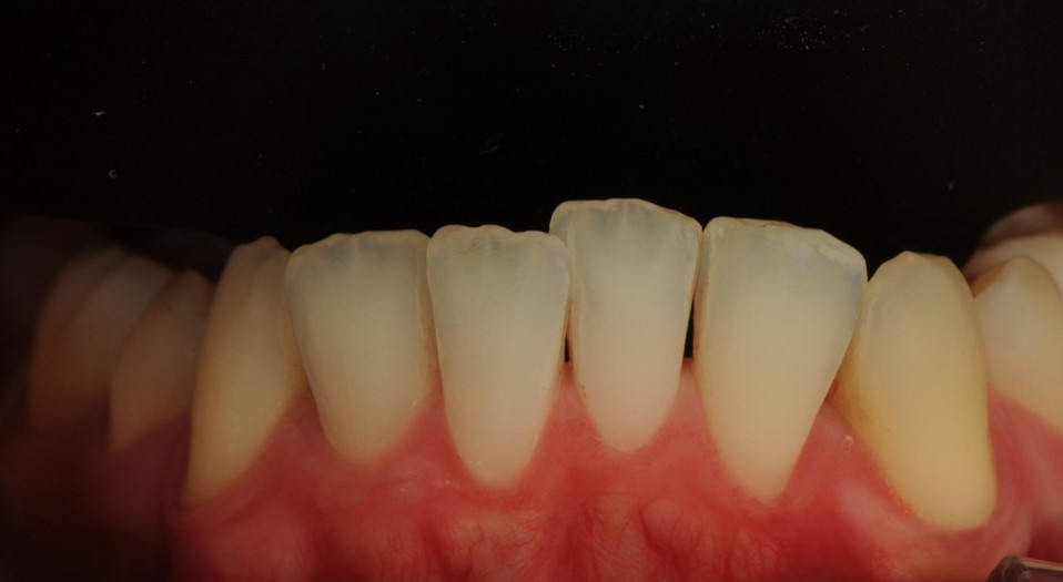 dents inferiors